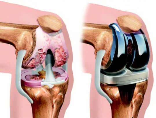 Outcome of knee replacement for osteoarthritis