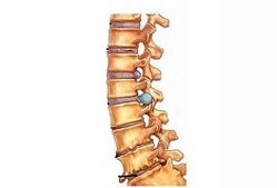 Stages of development of cervical osteochondosis