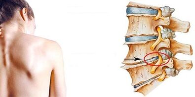 The development mechanism of cervical osteochondosis