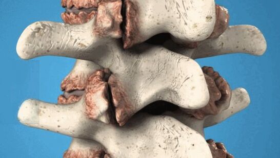 Osteophytes of the vertebrae - pathological growth that damages the nerves and blood vessels