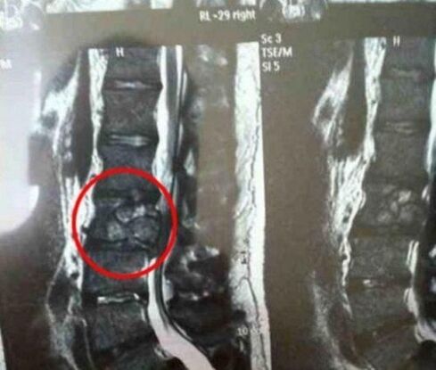 The tumor of the spine in the image