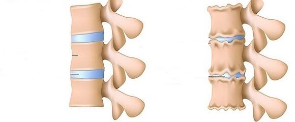 Healthy and osteochondrosis vertebral column