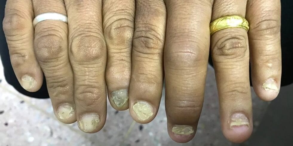 Swelling of the fingers and deformation of the nail plate may indicate the development of psoriatic arthritis.