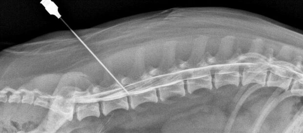 blockage of the spine with osteochondrosis