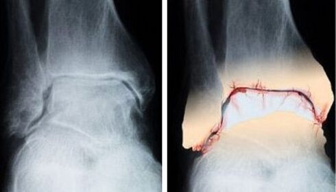 healthy and osteoarthritic joint